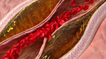 Le risque de thrombo-embolie artérielle associée au cancer très variable selon les localisations