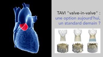 TAVI valve-in-valve pour bioprothèse percutanée dégénérée