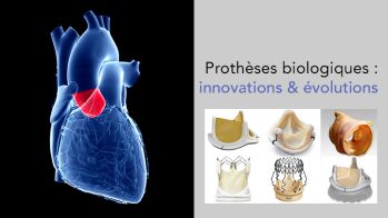 Prothèses biologiques chirurgicales : des évolutions en continu