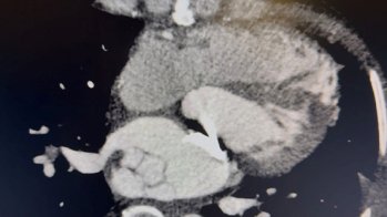 Complication rare d’un remplacement valvulaire mitral évoluant à bas bruit
