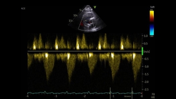 Quand la sonde de défibrillateur danse, la tricuspide trinque