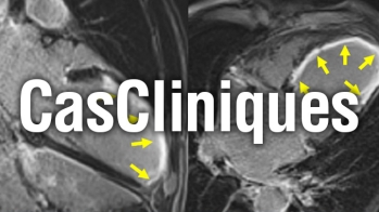 Imagerie cardiaque : cas clinique "Attention infarctus du myocarde méchant !"