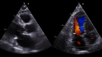 Une amylose comme aucune autre !