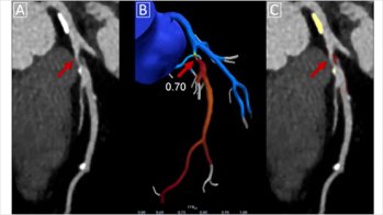 Nouvelles modalités d'évaluation du risque cardiovasculaire
