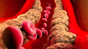 Hypercholestérolémie familiale homozygote : le risque d'infarctus du myocarde est plus élevé chez les hommes que chez les femmes