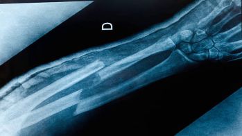 Risque de fracture plus que doublé après l'initiation d'un traitement antihypertenseur chez les patients âgés institutionnalisés