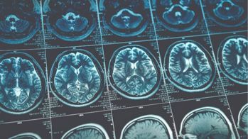 Hématome sous-dural chronique: l'embolisation de l'artère méningée moyenne bénéfique en ajout des soins standard