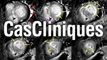 Imagerie cardiaque : cas clinique "Bilan d’HVG : et si ce n’était pas si simple que ça…"