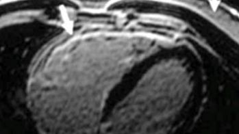 Dysplasie arythmogène du ventricule droit 