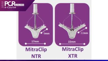 Étude EXPAND : le traitement percutané de l’IM secondaire de grade ≥ 3 par MitraClip NTR/XTR est une technique sûre et efficace