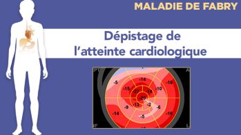 Dépistage de l’atteinte cardiologique en cas de maladie de Fabry