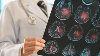 AVC :  la thrombolyse par ténectéplase semble raccourcir les délais de prise en charge intrahospitalière par rapport à l'altéplase