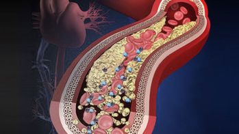 La place des inotropes dans l’insuffisance cardiaque aigüe