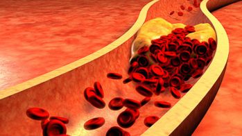 Post-syndrome coronaire aigu : restons simples et pratiques