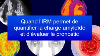 Quand l'IRM permet de quantifier la charge amyloïde et d'évaluer le pronostic