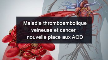 Maladie thromboembolique veineuse et cancer : nouvelle place aux anticoagulants oraux directs