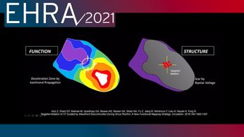 EHRA 2021 : ablation des tachycardies ventriculaires guidée par l’imagerie