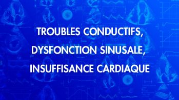 Amylose cardiaque : troubles conductifs, dysfonction sinusale, insuffisance cardiaque