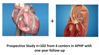 Stimulation post-TAVI