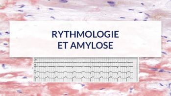 Anticoagulation par warfarin comparée aux AOD pour la fibrillation atriale chez les patients présentant une amylose cardiaque de type TTR