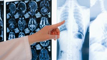 L'ablation de la fibrillation atriale divise par deux le risque de démence
