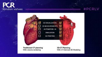 PCR London Valves : La planification 3D nouveau standard de la cardiologie structurelle
