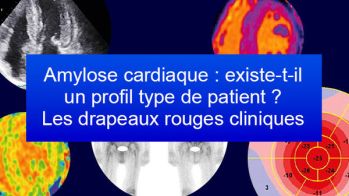 Amylose cardiaque : existe-t-il un profil type de patient ? Les drapeaux rouges cliniques
