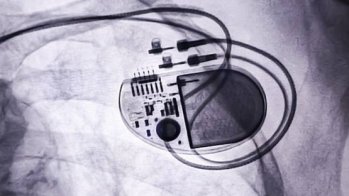 Identification d'une caractéristique à l'ECG permettant de mieux sélectionner les candidats à un défibrillateur implantable