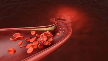 Resténose coronaire intra-stent: l'intérêt des ballonnets recouverts de paclitaxel confirmé par une étude américaine