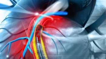 La lithotripsie intravasculaire efficace avant pose de stent dans les sténoses coronaires calcifiées sévères