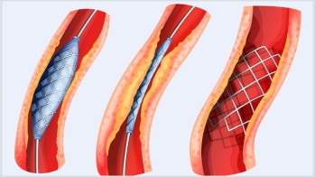 Traitement endovasculaire des anévrysmes de l'aorte abdominale