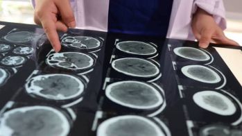 Identification de facteurs prédictifs de récidive d'AVC chez des patients avec une fibrillation atriale sous anticoagulation orale