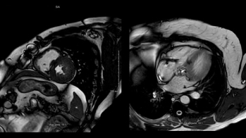 Une CMH toujours symptomatique