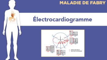 Électrocardiogramme dans la maladie de Fabry