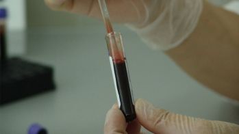 Suivre l'évolution temporelle du NT-proBNP serait efficace pour détecter les personnes les plus à risque d'insuffisance cardiaque
