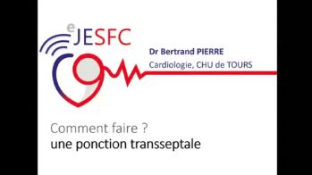Interventionnel :comment réaliser une ponction transseptale