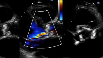 TAVI dans l'endocardite aortique destructrice