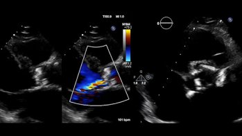 TAVI dans l'endocardite aortique destructrice