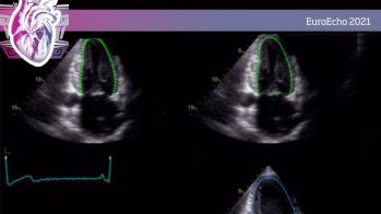 Place de l’intelligence artificielle dans notre quotidien au labo d’échocardiographie 