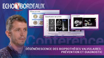 Dégénérescence des bioprothèses valvulaires : prévention et diagnostic
