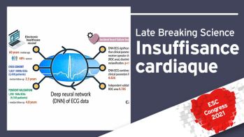 CardAIc-ECG : l’intelligence artificielle permet de prédire par ECG le risque d’insuffisance cardiaque !