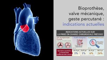 Chirurgie du rétrécissement aortique : choix du substitut, bioprothèse, prothèse mécanique et intervention de ROSS