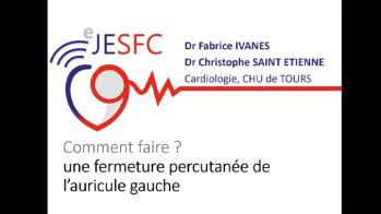 Interventionnel : comment faire fermer un auricule gauche