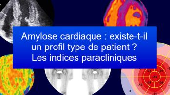 Amylose cardiaque : existe-t-il un profil type de patient ? Les indices paracliniques