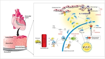Péricardite récidivante