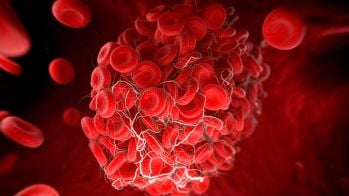 thrombus