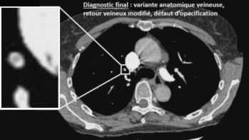 Récidive thromboembolique sous traitement anticoagulant : que faire ?