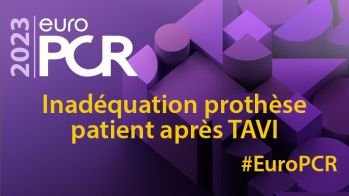 Impact à long terme de l'inadéquation prothèse-patient après TAVI