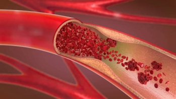 Premiers résultats comparatifs d'efficacité et de sécurité prometteurs pour un stent actif biorésorbable en fer