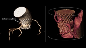 Deux ans après un TAVI : le silence du sinus coronaire gauche